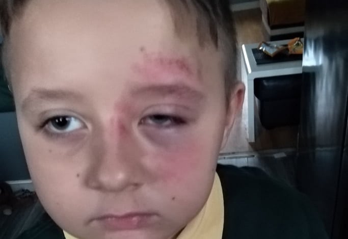 Ksenofobia w Wielkiej Brytanii! Siedmiolatek pobity w szkole za to, że jest Polakiem